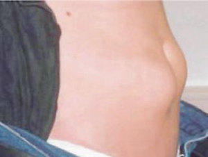 Lipohypertrophie Lipohypertrophie
